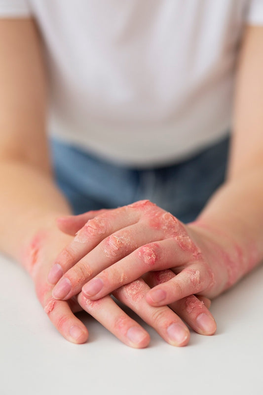 Stay One Step Ahead of Inflamed Skin