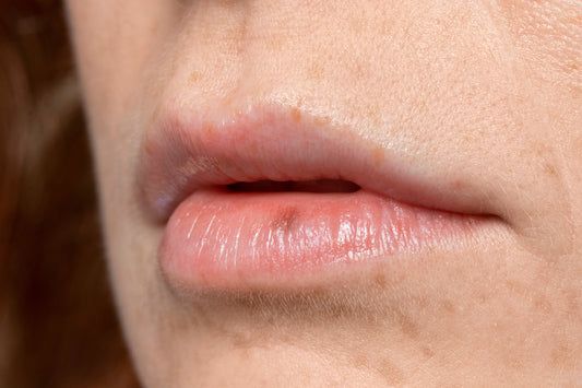 Understanding Perioral Dermatitis