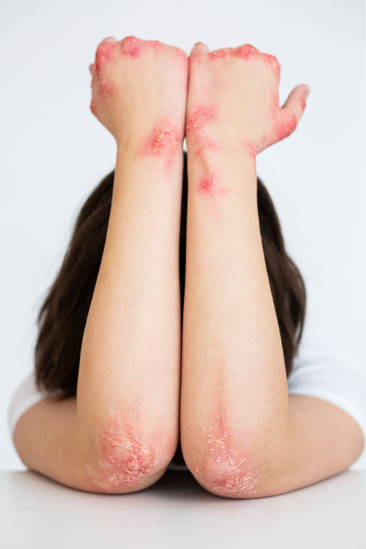 Eczema